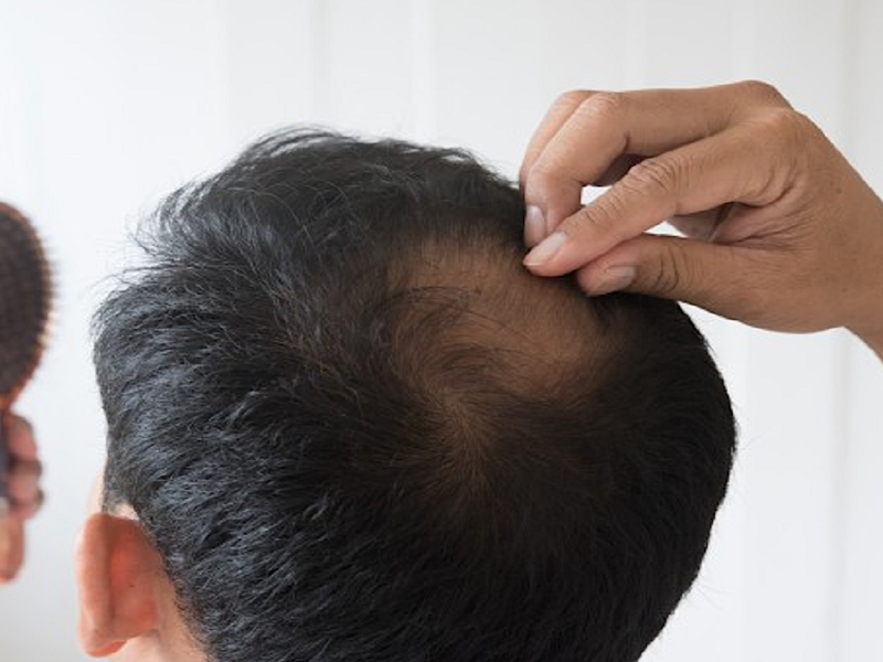کوکتل ریزش مو ارثی