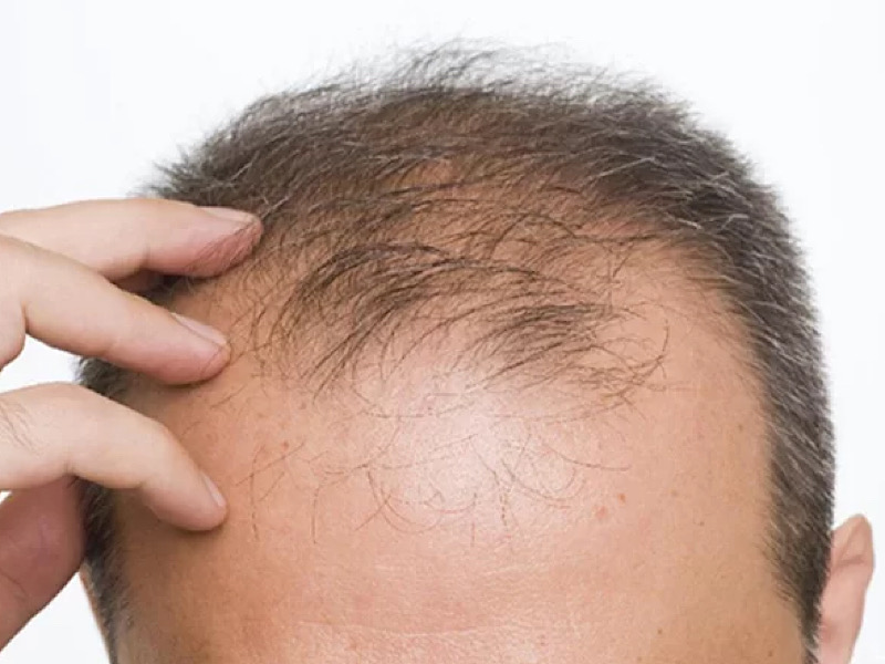 کوکتل ریزش مو ارثی و مزایای آن
