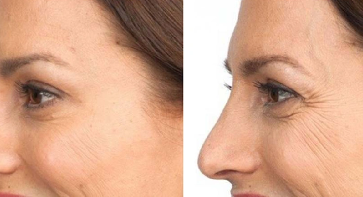 سوالات درباره باورهای غلط رایج درباره بوتاکس