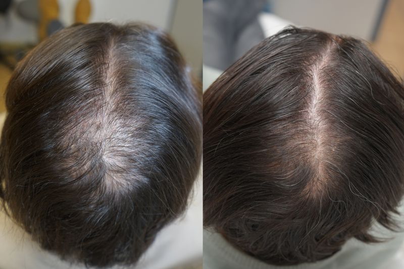 درمان ریزش مو شدید با کوکتل