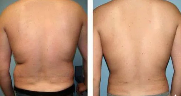 مزایای استفاده از کوکتل‌های چربی‌سوز برای تخلیه چربی های بدن_کوکتل فسفات مزولایک