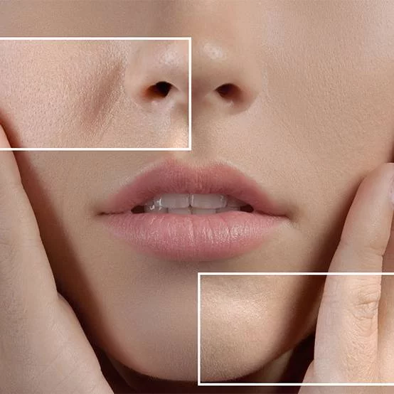 درمان منافذ باز صورت با کوکتل_مونودوز 2%Hyaluron