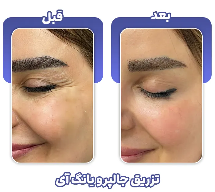 جالپرو یانگ آی تیک آبی